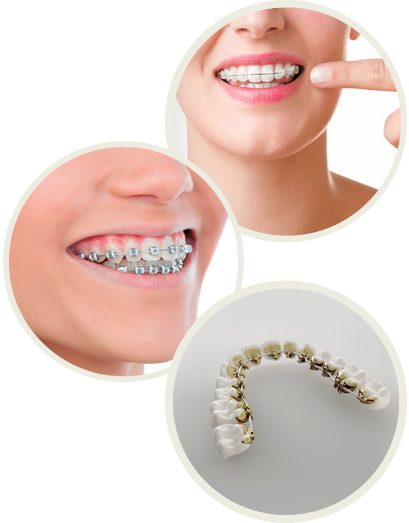 Braces Orthodontics Treatment