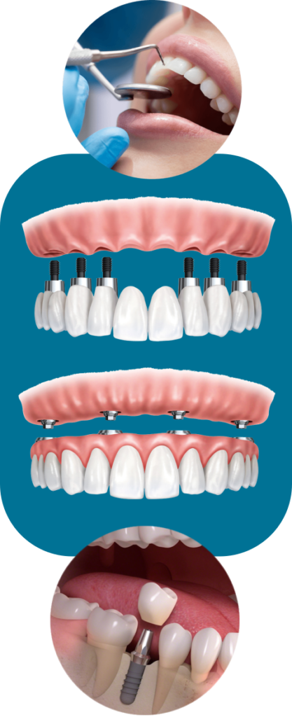 Dental Implant